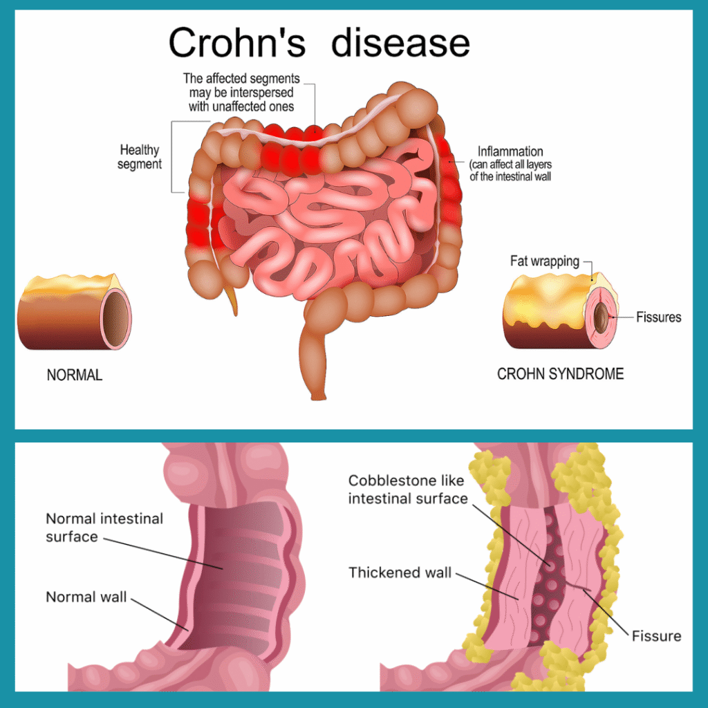 Crohn's disease