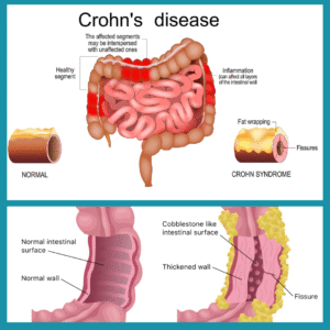 Crohn's disease